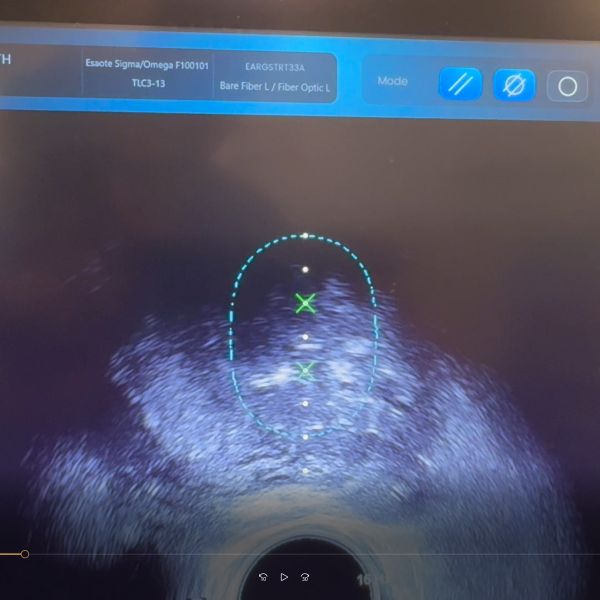 Echolaser Transperineal Prostate Ablation
